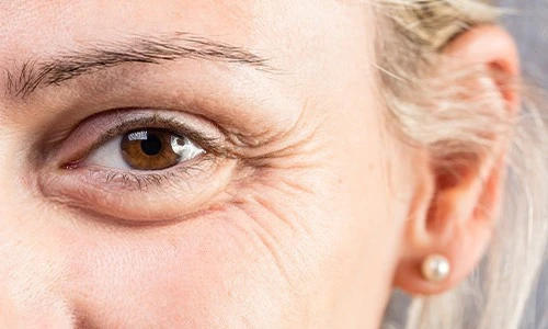 Eye lift 