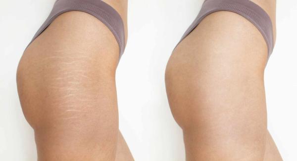 Soins vergetures