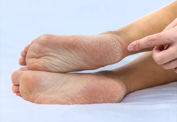 Soin extrême de la plante des pieds